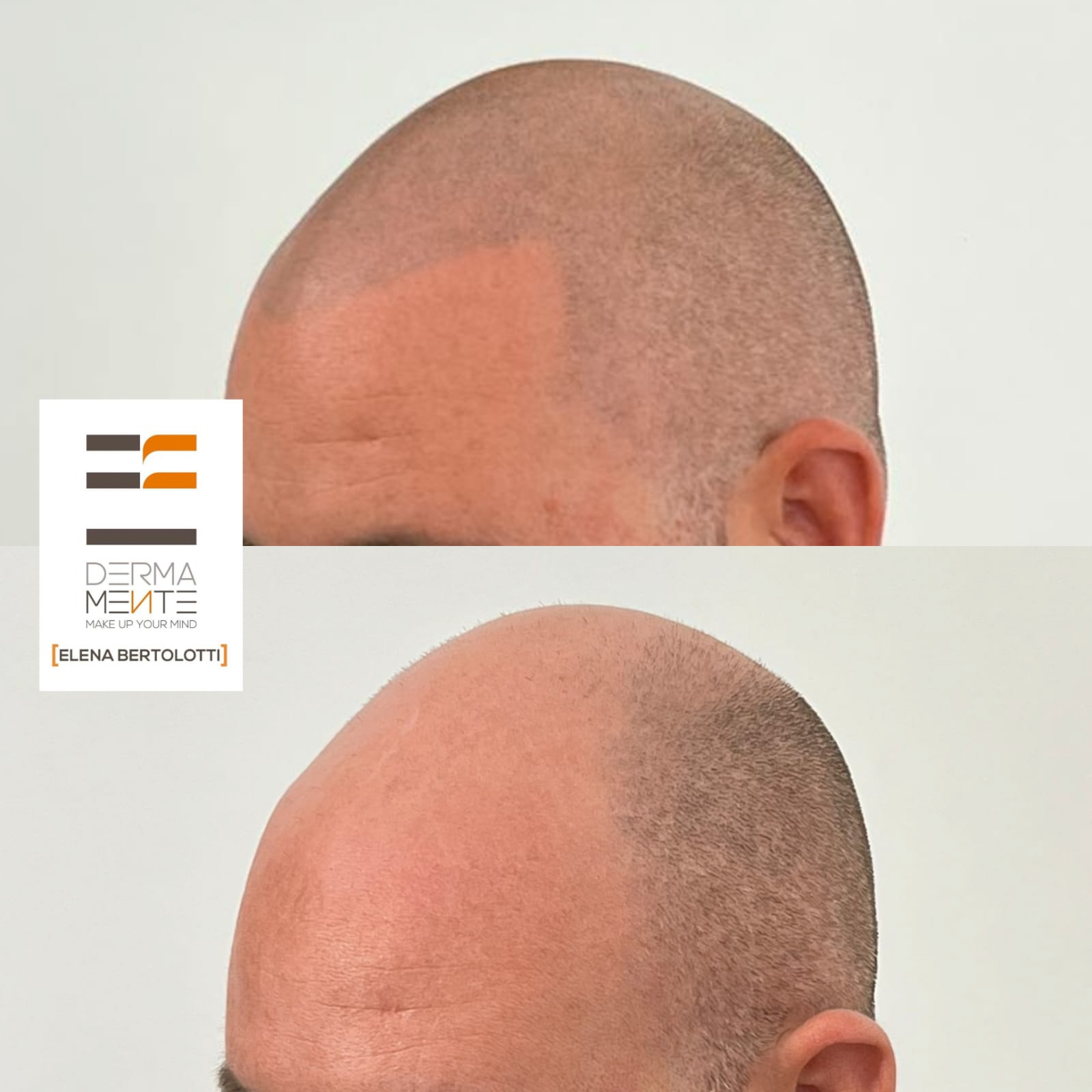 Tricopigmentazione